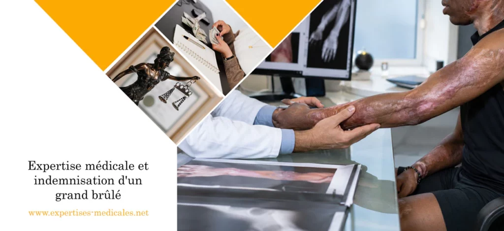 Expertise médicale et indemnisation d'un grand brûlé