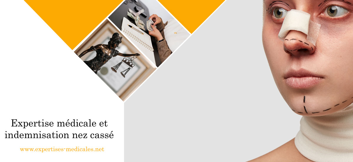Expertise médicale et indemnisation nez cassé