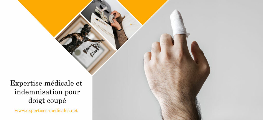Expertise médicale et indemnisation pour doigt coupé