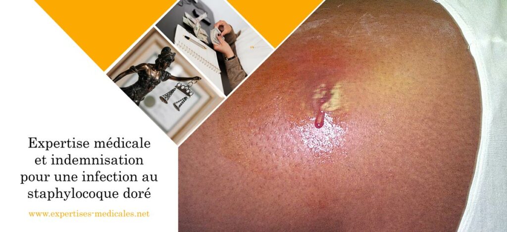 Expertise médicale et indemnisation pour une infection au staphylocoque doré