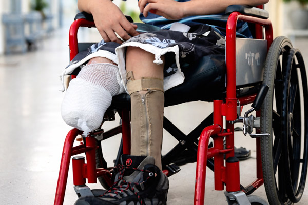Impact majeur sur la mobilité après une perte de jambe